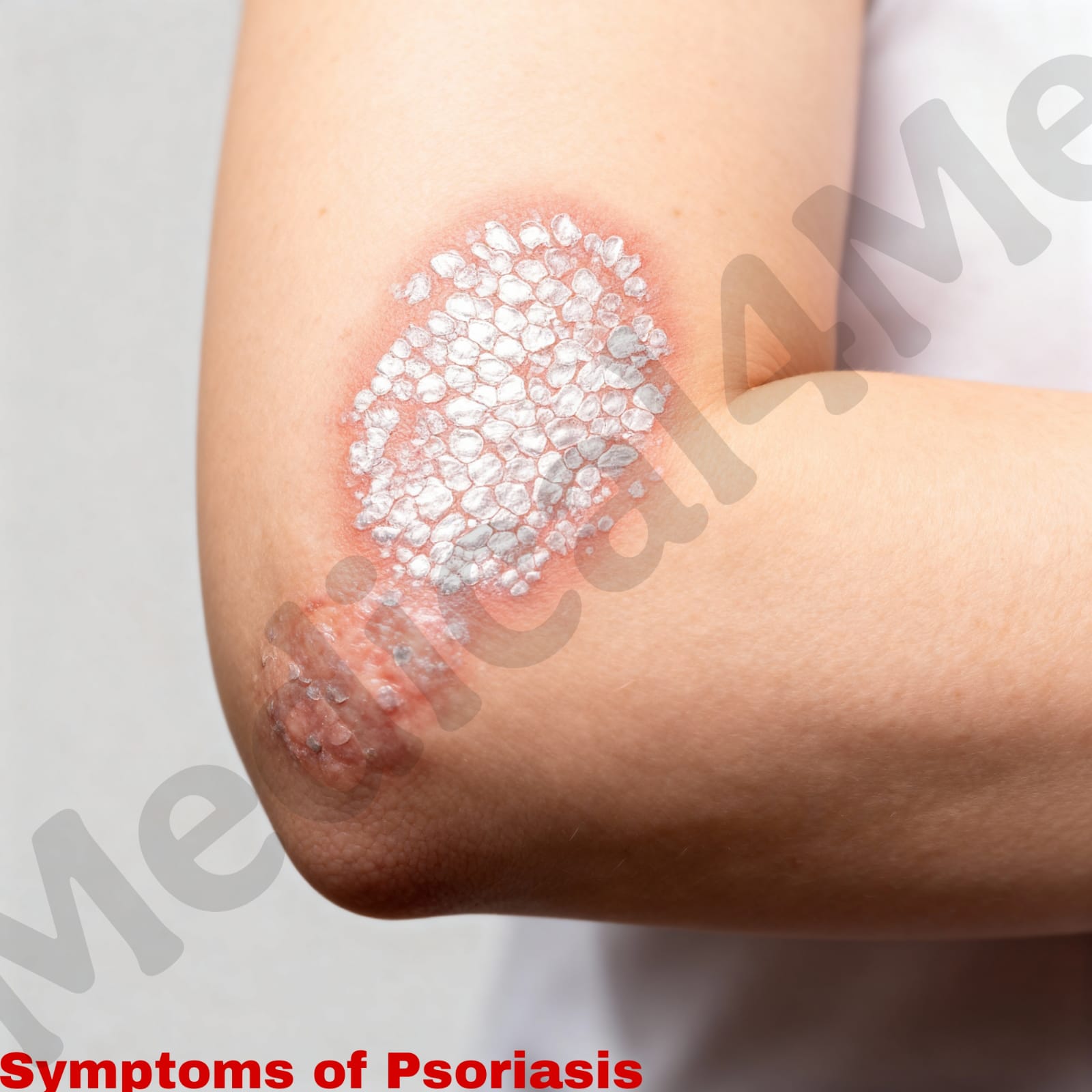 Psoriasis symptoms and warning signs visual guide
